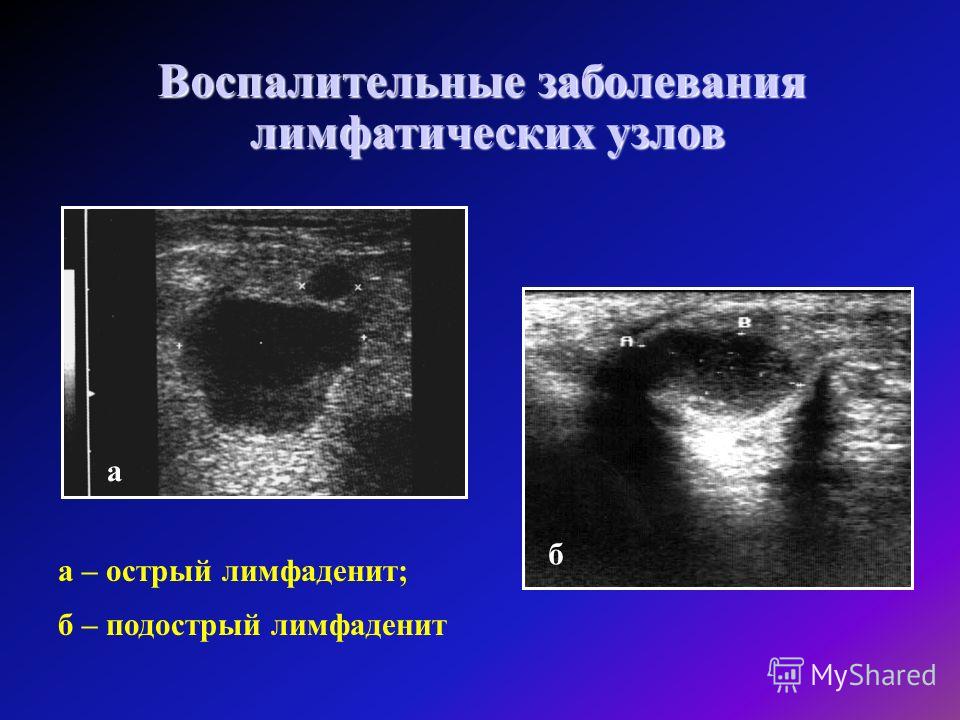 Метастаз в подмышечный лимфоузел. УЗИ анатомия лимфатических узлов. УЗИ поверхностных лимфатических узлов .. Мезентериальный лимфаденит УЗИ. Гнойный лимфаденит на УЗИ.
