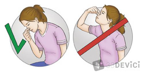 как правильно помочь при носовом кровотечении