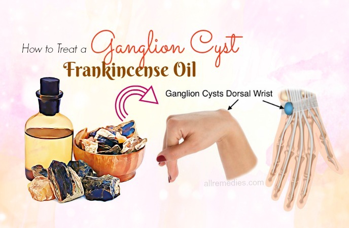 how to treat a ganglion cyst 