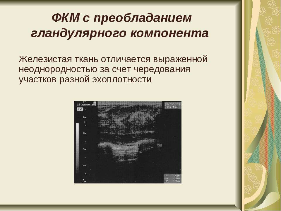 Фиброзная мастопатия с преобладанием железистого компонента