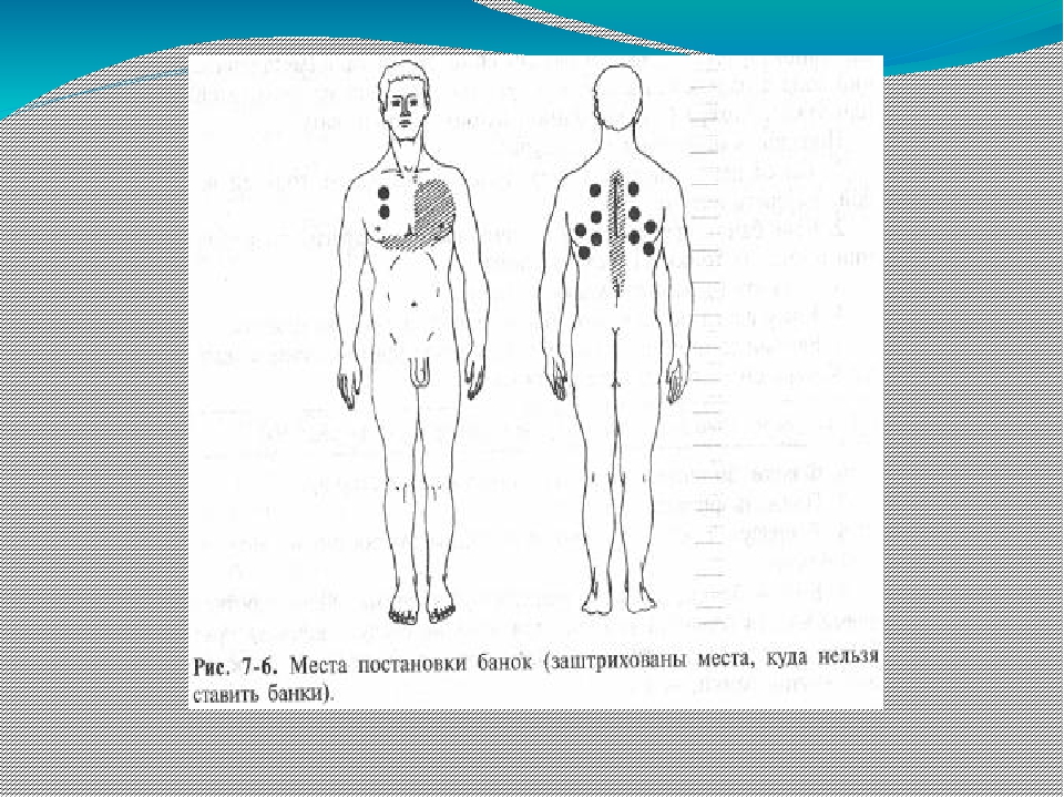 Куда ставить банки на тело. Куда ставить банки на спину схема при кашле. Схема постановки банок при бронхите. Схема постановки банок при кашле. Схема постановки банок на спину при кашле.