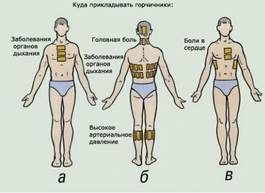 Горчичники при кашле. Как ставить, куда, инструкция взрослым и детям