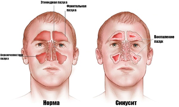 Промывка носа солевым раствором. Рецепт, как делать шприцом