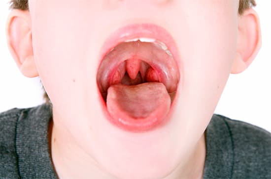Воспаление аденоидов у детей: лечение