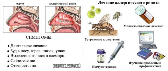 sopli-allergichesky-rinit