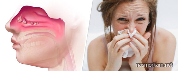 Промывание носа перекисью водорода: лечим насморк и гайморит