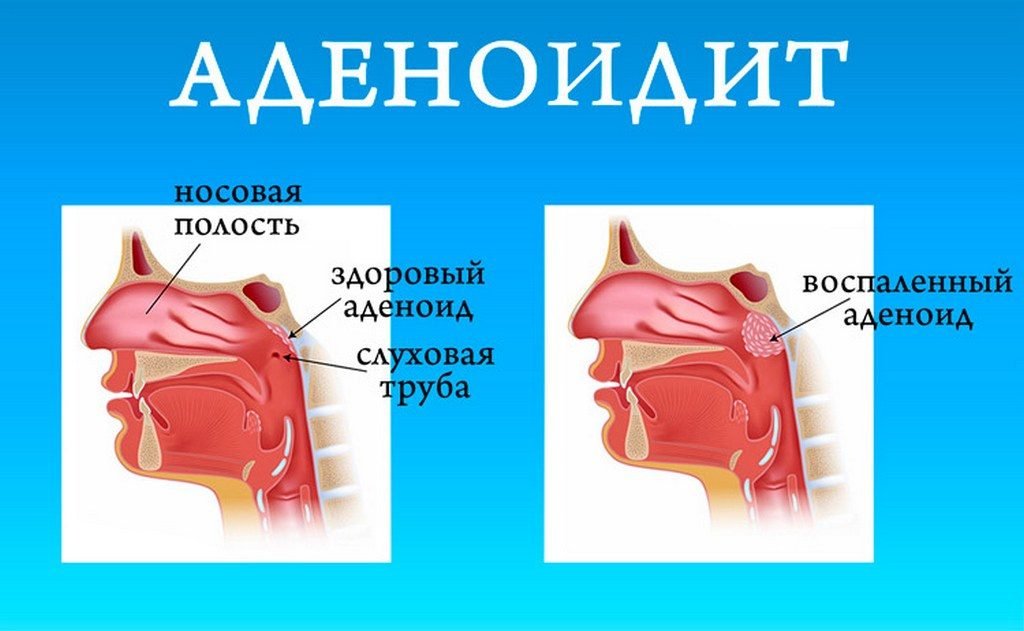 Показания к удалению миндалин