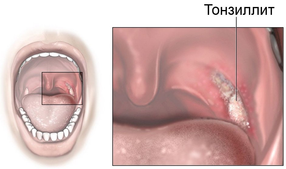 Тонзиллит
