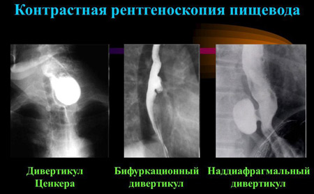 Дивертикулит пищевода