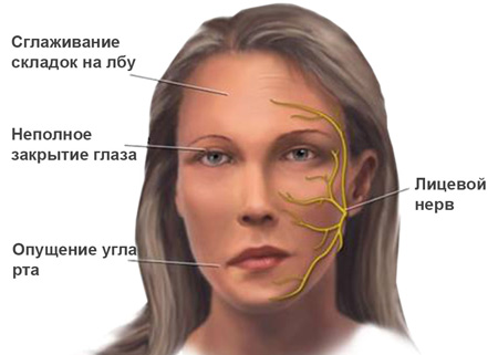 Миастения