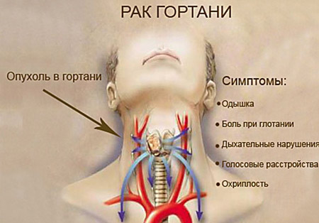 Рак гортани на разных стадиях