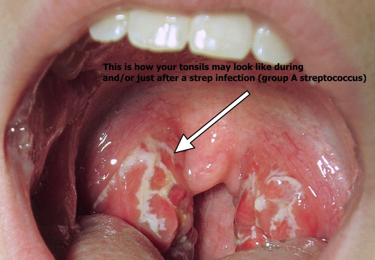 Tonsils post strep infection may have holes filled with white or yellow pus