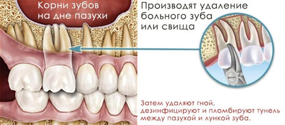 могут ли при гайморите болеть зубы