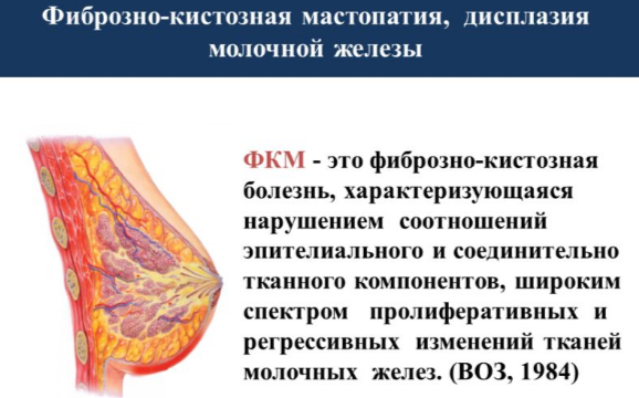 Фиброзно-кистозная мастопатия молочной железы