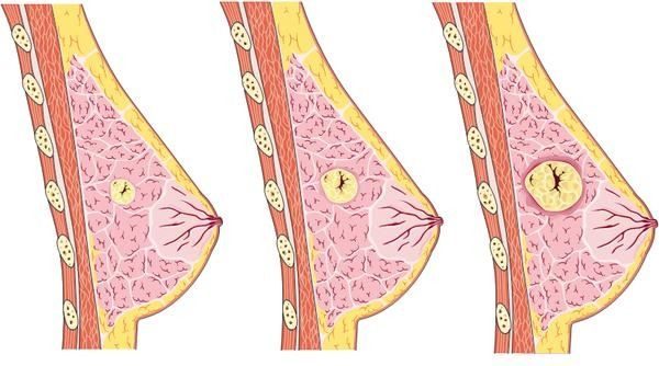 Последствия нелеченной мастопатии