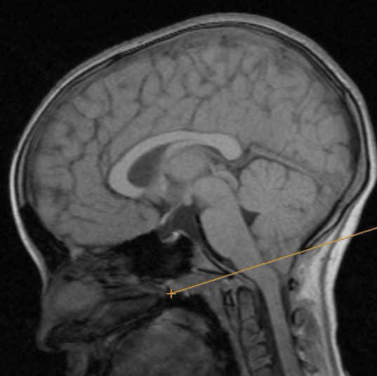 Мр картина низкого расположения миндалин мозжечка