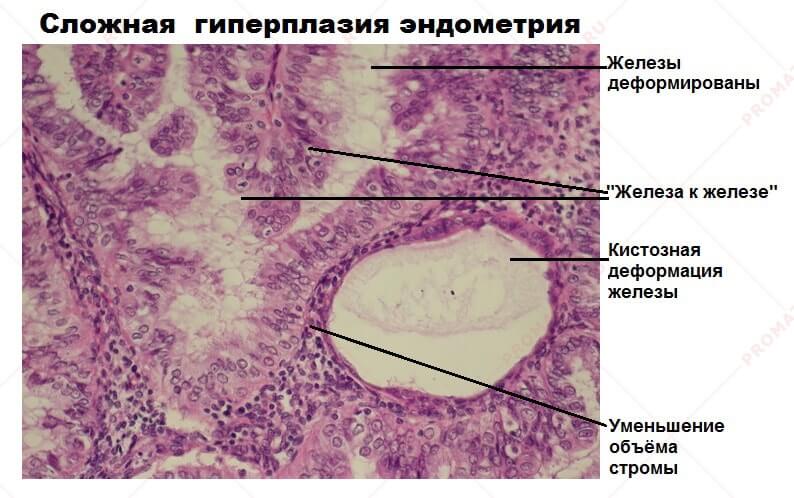 Предрак эндометрия. Железисто-кистозная гиперплазия эндометрия микропрепарат. Железистый эпителий гистология матки. Сложная гиперплазия эндометрия гистология. Простая гиперплазия эндометрия гистология.