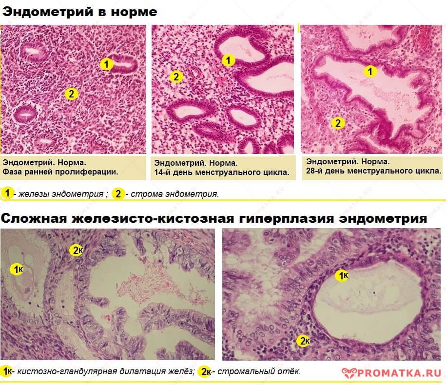 Эндометрий: норма и патология