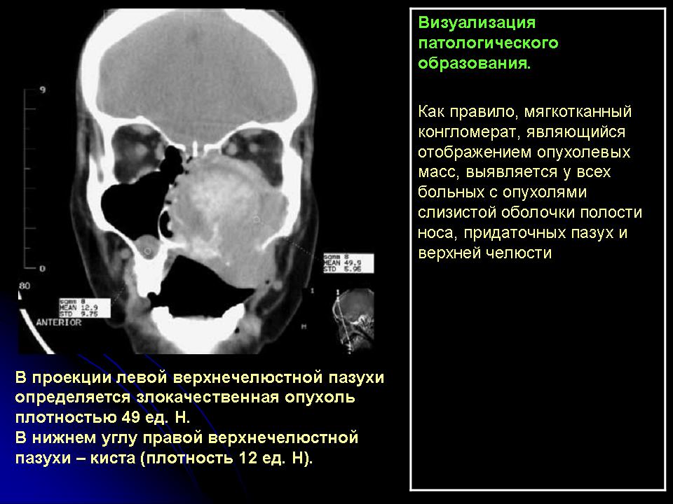 Рак полости носа и придаточных пазух презентация