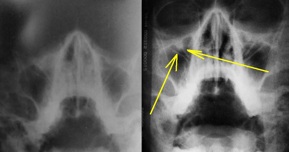 Синусит на рентгене