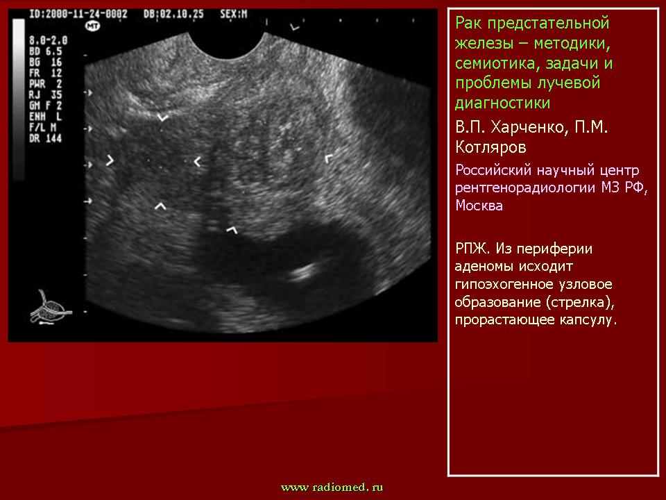 Узи признаки дгпж. ДГПЖ на УЗИ предстательной железы. УЗИ предстательной железы трансабдоминально. УЗИ доброкачественная гиперплазия предстательной железы. Карцинома предстательной железы УЗИ.
