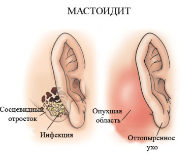Травматический отит Причины кровотечения