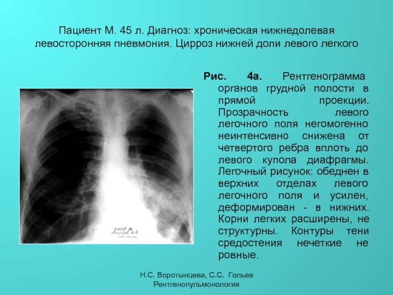 К т легких 10. Правосторонняя нижнедолевая очаговая пневмония рентген. Нижнедолевая очаговая пневмония рентген. Левосторонняя нижнедолевая пневмония рентген. Левосторонняя нижнедолевая пневмония рентгенограмма.