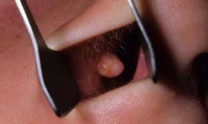 Папиллома внутри носа
