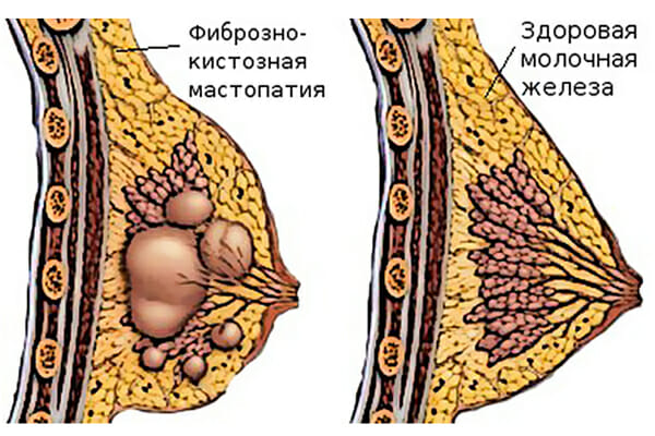 Фиброзно-кистозная мастопатия на груди