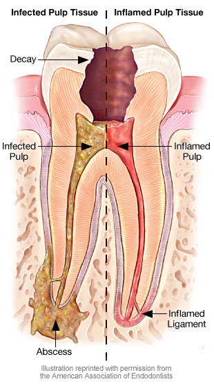 Infected and inflamed pulp tissue