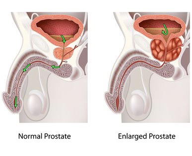 normal and enlarged prostate