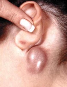 Swollen Lymph Nodes behind Ear