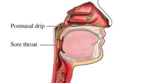 Post Nasal Drip causing constant cough and tickly throat