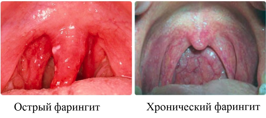 острый и хронический фарингит разница фото